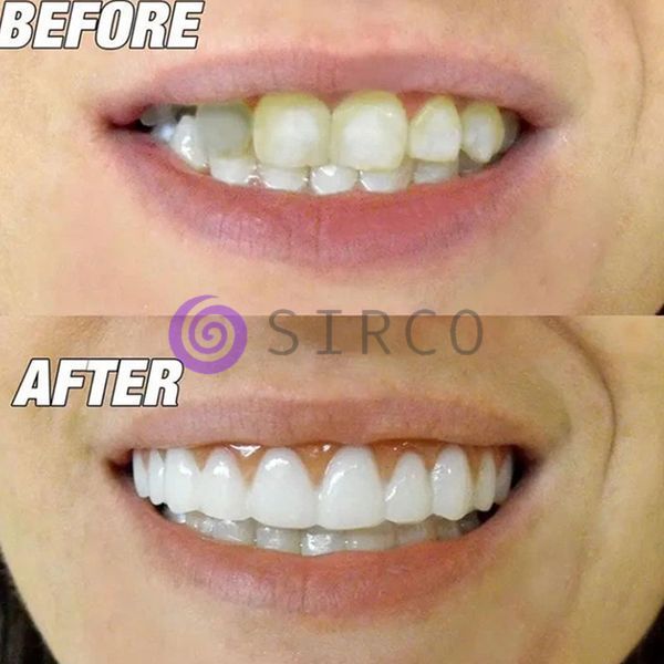 Знімні вініри на верхні та нижні щелепи Snap On Smile в кейсі/Накладки на зуби/Вініри з яснами(AX) Знімні вініри на верхні та нижні щелепи Snap On Smile в кейсі/Накладки на зуби/Вініри з яснами(AX) фото